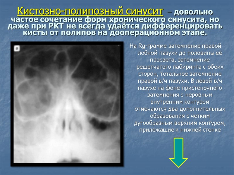 Кистозно-полипозный синусит – довольно частое сочетание форм хронического синусита, но даже при РКТ не